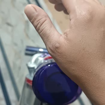 Süpürge Kullanımı Sonrası Parmakta Deformasyon Sorunu