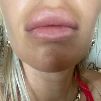 Dudak Dolgusu Yıllardır Erimedi Mağduriyetim Giderilmiyor