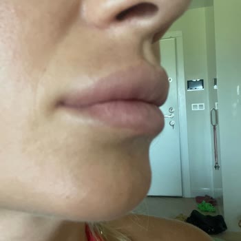 Dudak Dolgusu Yıllardır Erimedi Mağduriyetim Giderilmiyor