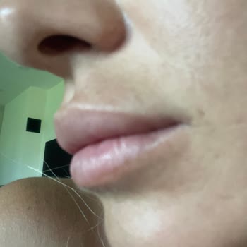 Dudak Dolgusu Yıllardır Erimedi Mağduriyetim Giderilmiyor