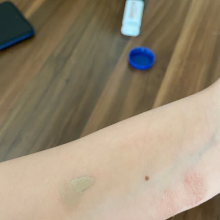 Yanlış Ürün Ve Alerjik Reaksiyon Sonrası Mağduriyet