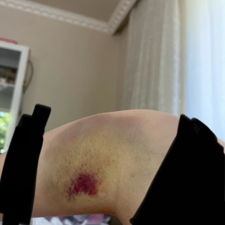 Stajyer Hemşirenin Dikkatsizliği Kolumda Sorun Yarattı