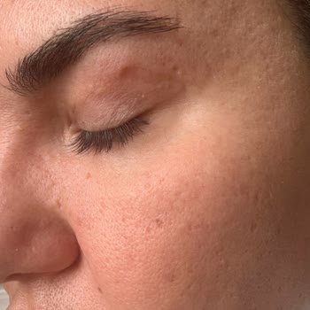 Göz Kapağı Ameliyatı Sonrası Kalıcı İz Ve İlgisizlik