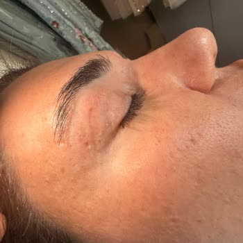 Göz Kapağı Ameliyatı Sonrası Kalıcı İz Ve İlgisizlik