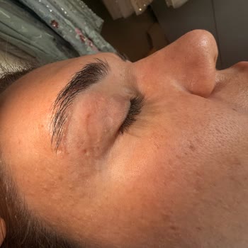 Göz Kapağı Ameliyatı Sonrası Kalıcı İz Ve İlgisizlik