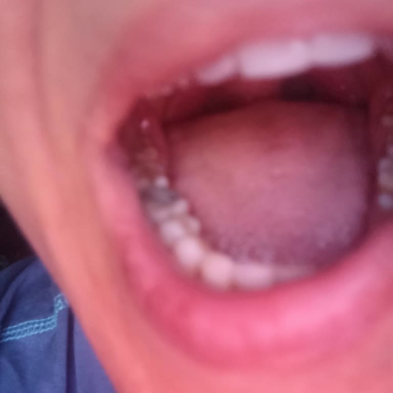 Eski Yöntemlerle Yapılan Dolgu Ve İlgisiz Yaklaşım