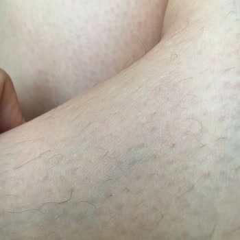 Lazer Epilasyonda Yanık Ve İletişim Engeli Yaşadım