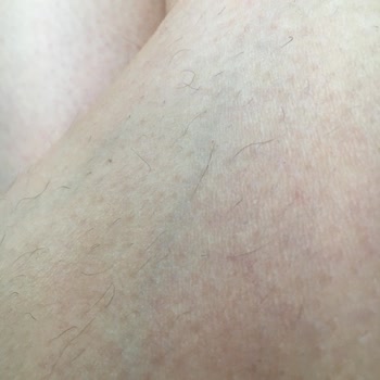 Lazer Epilasyonda Yanık Ve İletişim Engeli Yaşadım