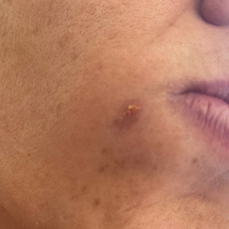 Lazer Epilasyon Sonrası Yüzümde Yanık Ve Kalıcı İz Oluştu