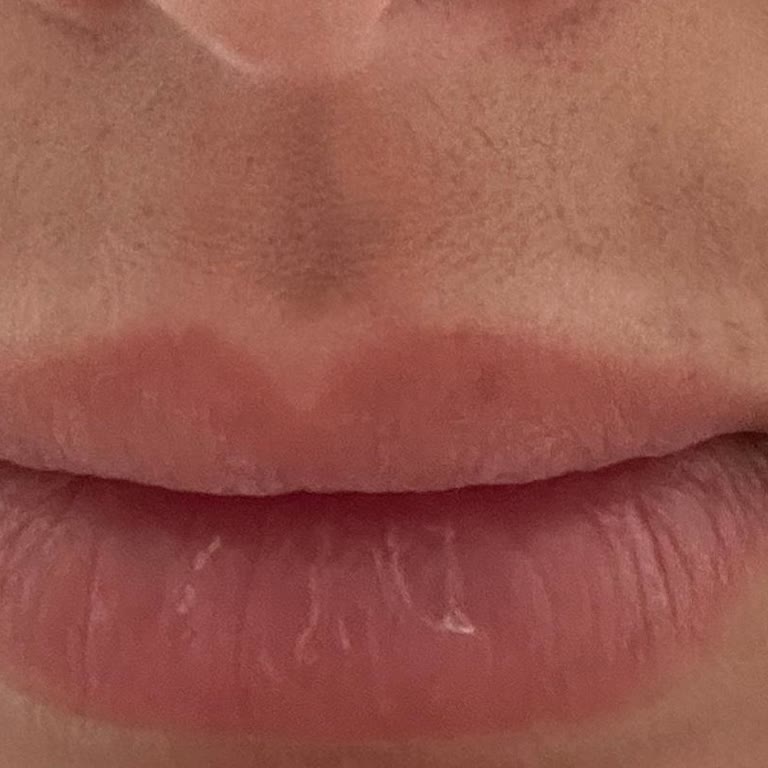 Lazer Epilasyon Sonrası Kalıcı Yanık İzleri Ve İlgisizlik