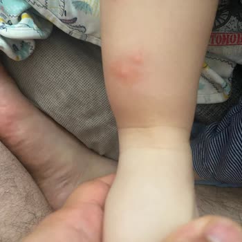 Sivrisinek Sorunu Ve Yetersiz İlaçlama Nedeniyle Bebeğimiz Risk Altında