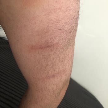 Gold Plazma İşlemi Sonrası İzler Arttı, Ek Seans İçin Ücret Talep Edildi