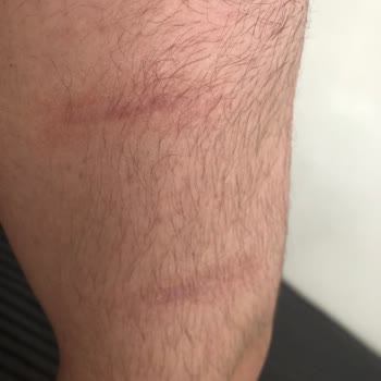 Gold Plazma İşlemi Sonrası İzler Arttı, Ek Seans İçin Ücret Talep Edildi