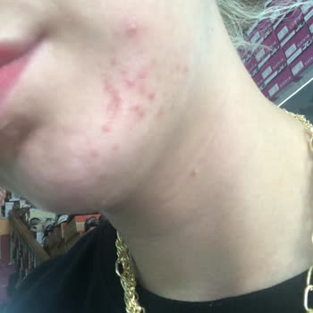 Dove Sabun Sonrası Yüzümde İlk Kez Yoğun Sivilce Oluştu