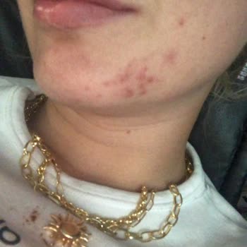 Dove Sabun Sonrası Yüzümde İlk Kez Yoğun Sivilce Oluştu