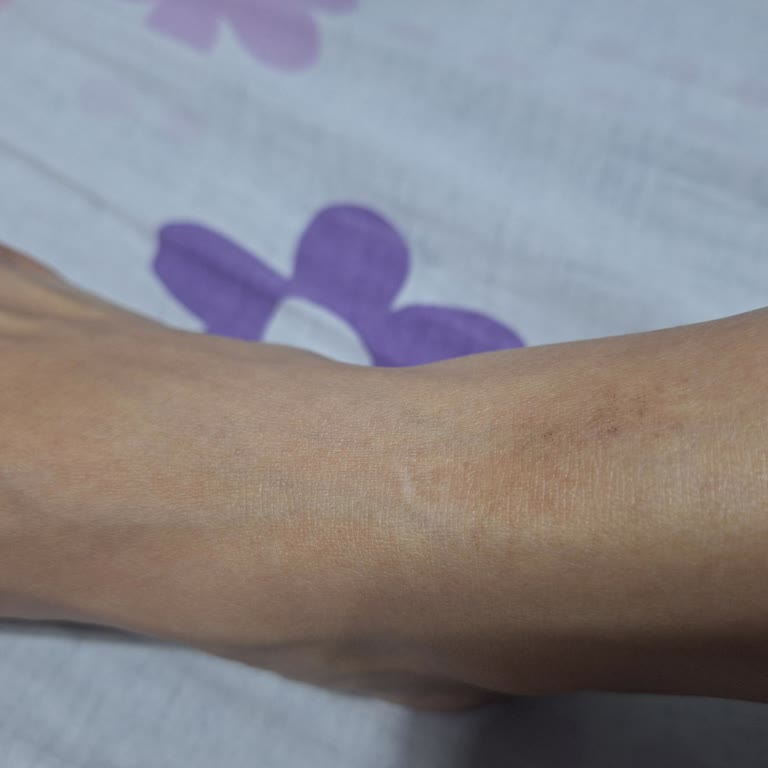 Özel İbn-i Sina Hastanesi (Siirt) Lazer Epilasyon Sonrası Cildimde Kalıcı Yanık Ve Lekeler Oluştu