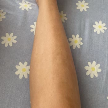 Aris Güzellik Merkezleri Lazer Epilasyon Sonrası Yanık ve Randevu Mağduriyeti