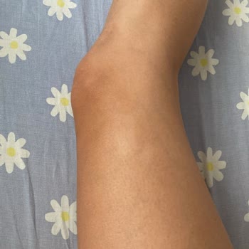 Aris Güzellik Merkezleri Lazer Epilasyon Sonrası Yanık ve Randevu Mağduriyeti