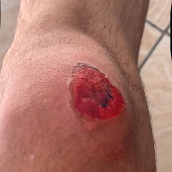 Acil Serviste Yetersiz Müdahale Ve İlgisizlik