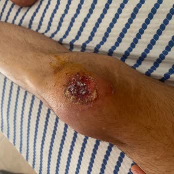 Acil Serviste Yetersiz Müdahale Ve İlgisizlik