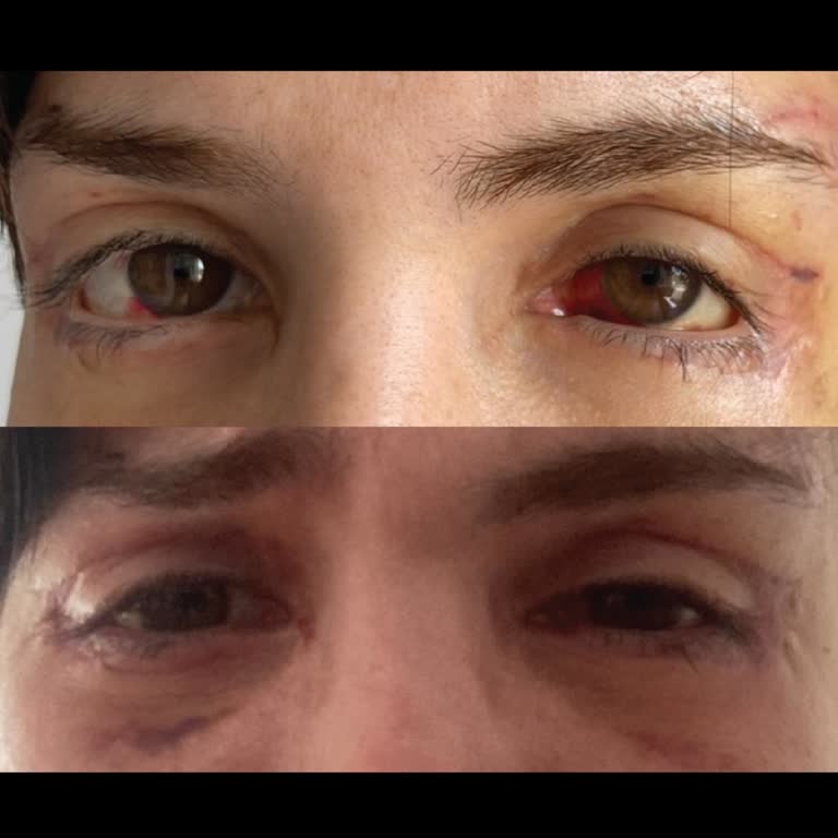 Göz Kapağı Estetiği Sonrası Kalıcı Zarar Ve Sistematik Sorunlar