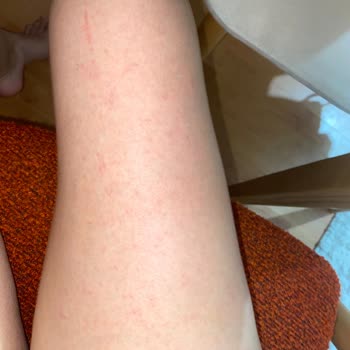 Nivea Sıkılaştırıcı Krem Bacağımda Alerji Ve Kaşıntı Yaptı