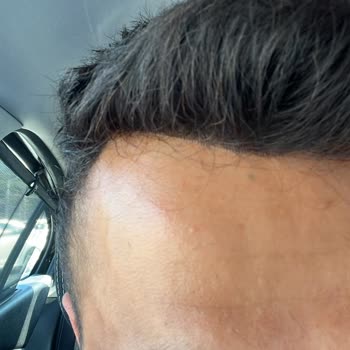 Özcan Zencirli Hair & Macke-up Protez Saçımı Yapıştıramadı