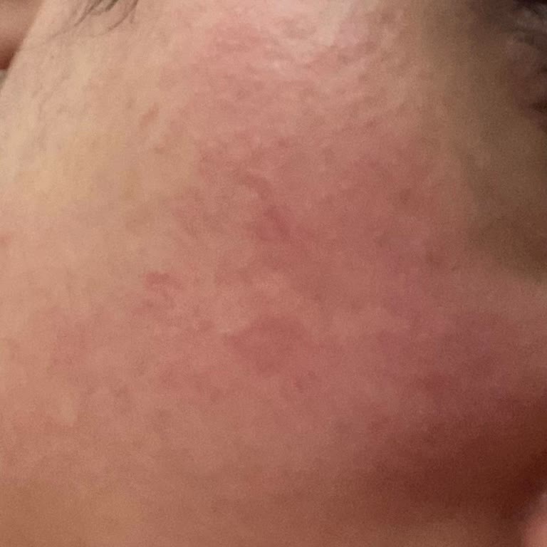 Gratis'ten Aldığım Ürün Cildimi Yaktı Ve İzler Oluştu