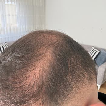 Saç Ekimi Sonrası Hayal Kırıklığı Ve Sonuçta Değişmeyen Beklentiler