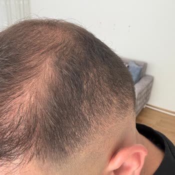 Saç Ekimi Sonrası Hayal Kırıklığı Ve Sonuçta Değişmeyen Beklentiler