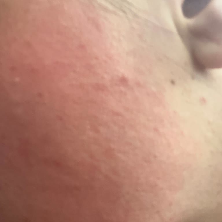 Dermokil Nemlendirici Maske Yüzümde Ciddi Yanma Ve Kızarıklık Yaptı