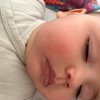 Bebeğimde Döküntüye Sebep Olan Ecowell Şampuan Ve Losyonunun Sağlık Riski