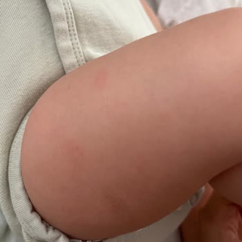 Bebeğimde Döküntüye Sebep Olan Ecowell Şampuan Ve Losyonunun Sağlık Riski