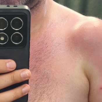 Sahte Güneş Kremi Yüzünden Tatilim Ve Sağlığım Mahvoldu