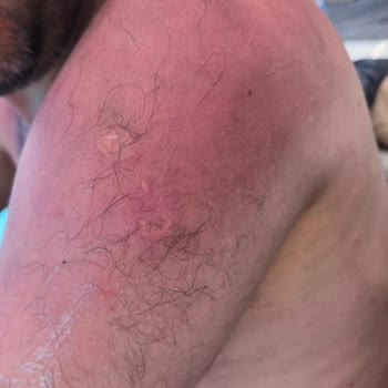 Sahte Güneş Kremi Yüzünden Tatilim Ve Sağlığım Mahvoldu