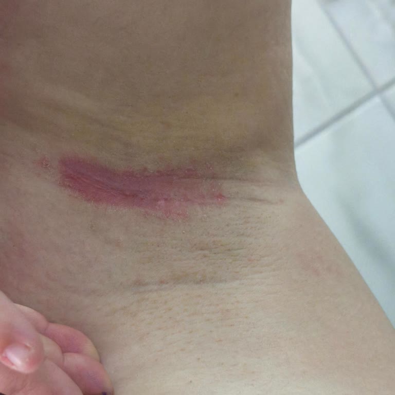 Koltuk Altımda Tahriş Ve Yara Yapan Ürün Deneyimi