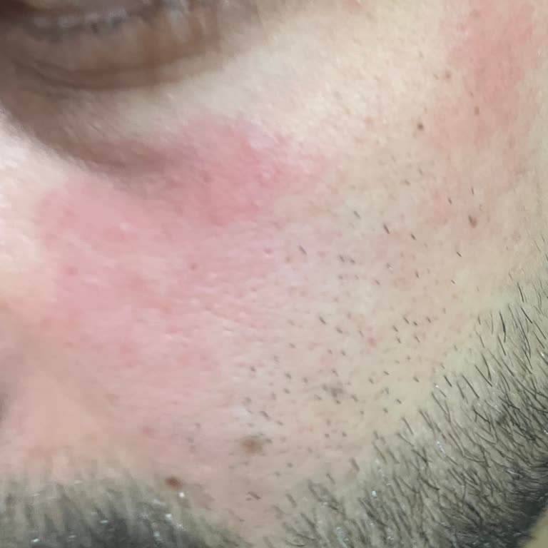 Yves Rocher Pure Menthe Face Wash Burned My Husband’s Skin