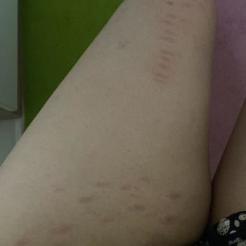 Queen Güzellik Salonu (Kars) İhmalkarlığı Yüzünden Vücudumda Belli Başlı Lekeler Kalıyor