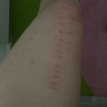 Queen Güzellik Salonu (Kars) İhmalkarlığı Yüzünden Vücudumda Belli Başlı Lekeler Kalıyor