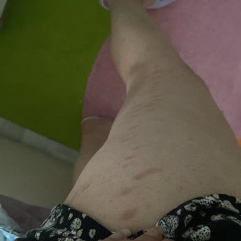 Queen Güzellik Salonu (Kars) İhmalkarlığı Yüzünden Vücudumda Belli Başlı Lekeler Kalıyor