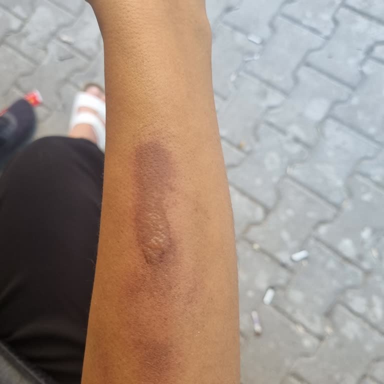 Lazer İşlemi Sonrası Yanık Ve İlgisiz Davranış