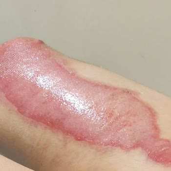 Lütfi Kırdar Şehir Hastanesi  Yara Ve Yanık Merkezi Şikayeti