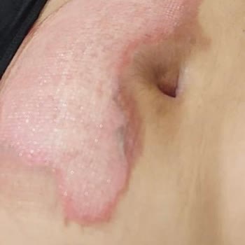 Lütfi Kırdar Şehir Hastanesi  Yara Ve Yanık Merkezi Şikayeti