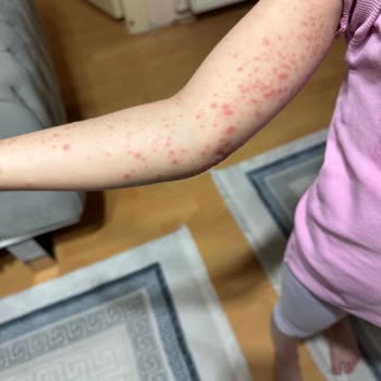 Oz Hotels İncekum Alanya'da Enfeksiyon Riski!