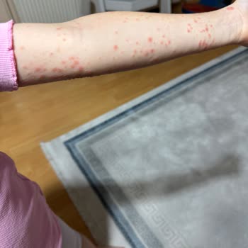 Otel Havuzundan Kaynaklanan Enfeksiyon Ve Mağduriyet