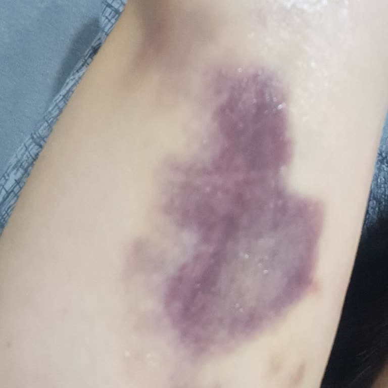 Hemşirenin İhmali Sonucu Kolumda Geçmeyen Morluk Oluştu