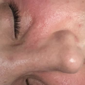 Caudalie Vinoperfect Serum y Crema Facial me irritaron la piel y causaron erupciones