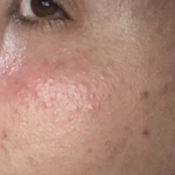 Caudalie Vinoperfect Serum y Crema Facial me irritaron la piel y causaron erupciones