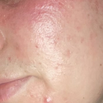 Caudalie Vinoperfect Serum y Crema Facial me irritaron la piel y causaron erupciones