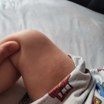 Bebeğim Möller's Balık Yağı Sonrası Alerjik Reaksiyon Geçirdi Ve Fiyat Farkı Yaşadım